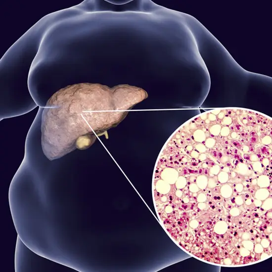 fatty liver index test